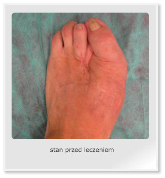 stan przed leczeniem