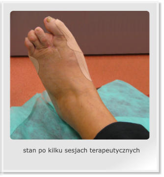 stan po kilku sesjach terapeutycznych